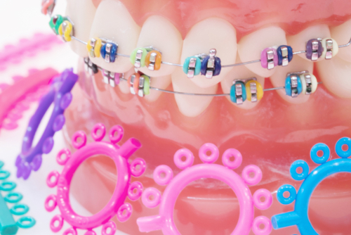 braces elastics mariana orthodontics monroe