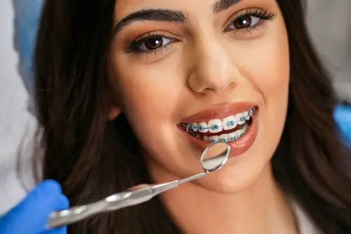 How Long Does It Take To Get Braces - Mariana Orthodontics Can Tell You