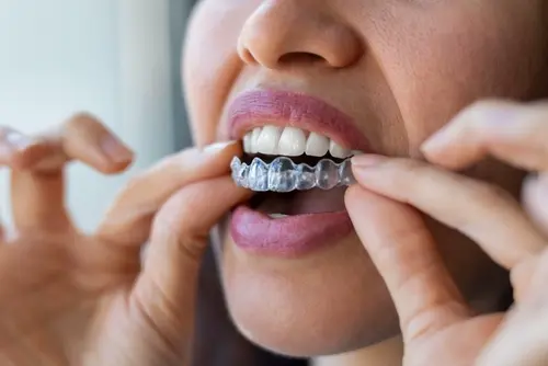 How Long Does Invisalign Treatment Take - Dr. Mariana Ortho Has The Answer