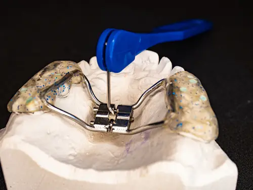 How a Rapid Palatal Expander Works - Dr. Mariana Orthodontics