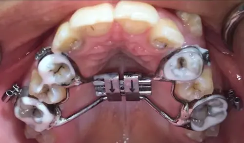 Benefits of 3D Printed bands in RPEs - Dr. Mariana Orthodontics