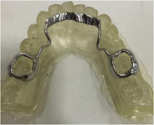 Composition of 3D Printed Bands - Dr. Mariana Orthodontics