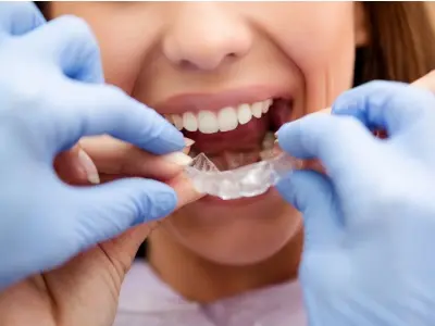 Get Customized Aligners from Mariana Orthodontics in Monroe - Mariana Orthodontics