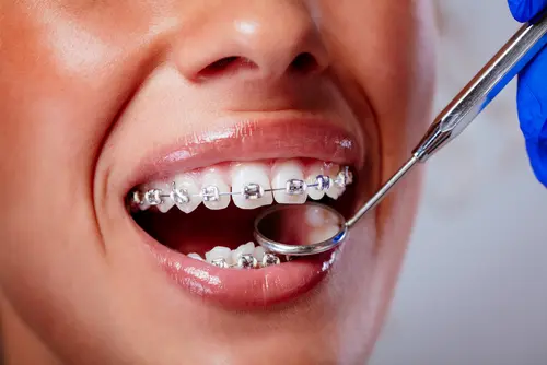 life with braces