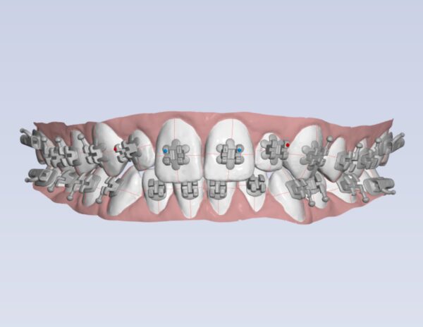 Super Shapes for WildSmiles Brackets - Dr. Mariana Orthodontics